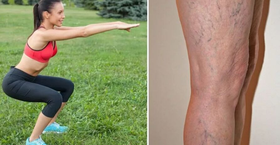 Legs for varicose veins