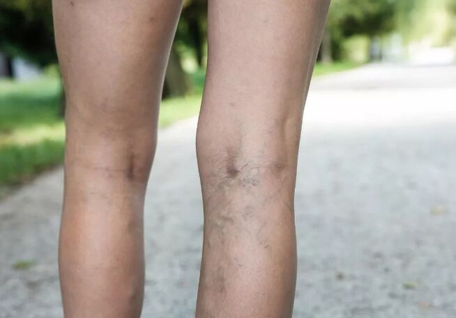 Varicose veins
