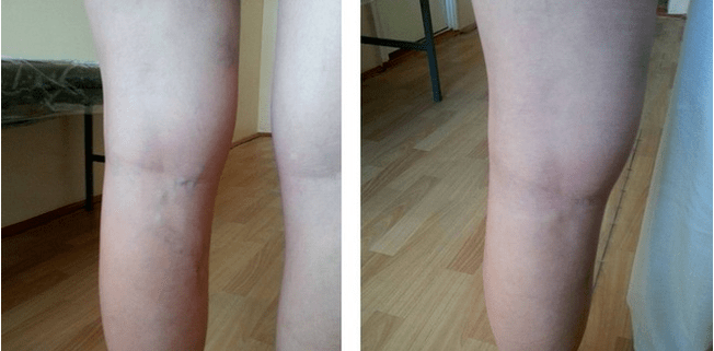 Varicose veins on their feet